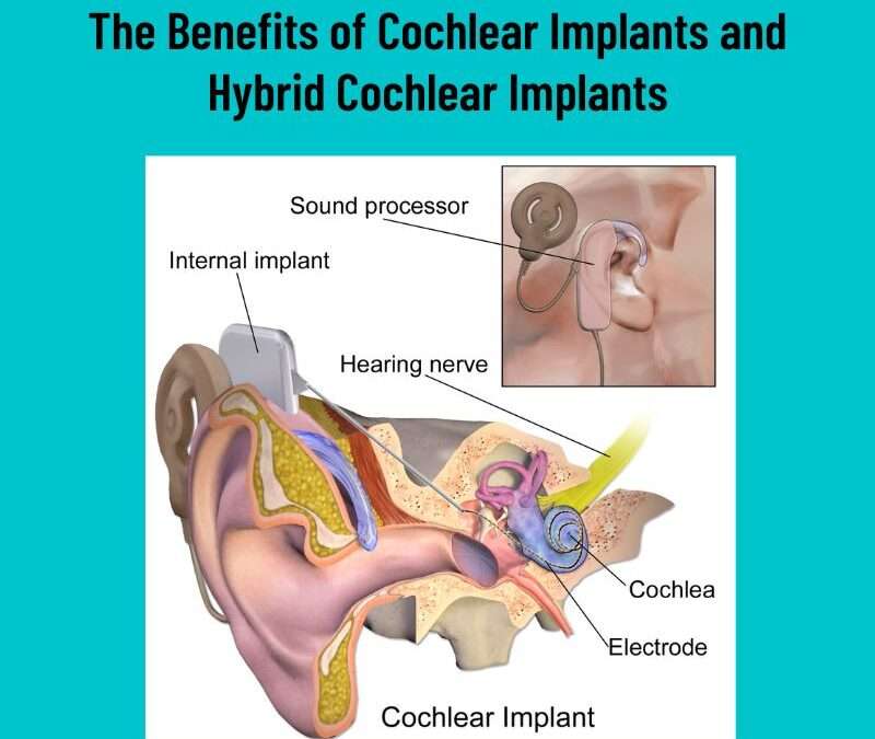 The Benefits of Cochlear Implants and Hybrid Cochlear Implants