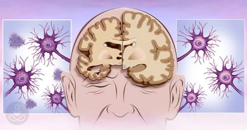 representation of Connection Between Hearing Loss and Dementia